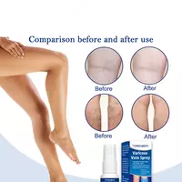 Varikoz tomirlari uchun sprey Chakana savdo