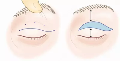 Пластика верхних век