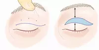 Пластика верхних век - по запросу