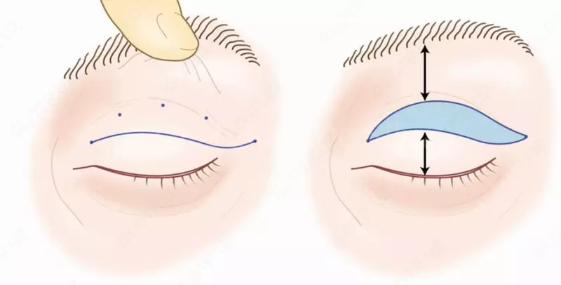 Пластика верхних век