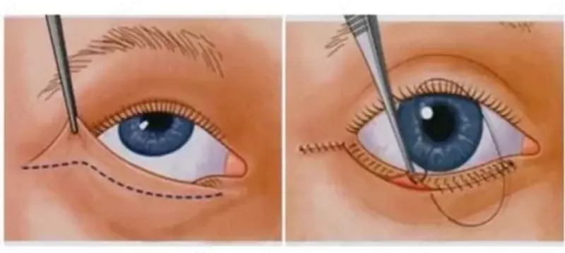 Пластика нижних век