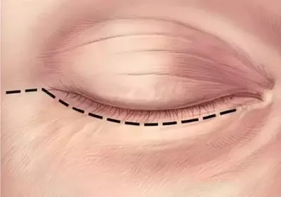 Pastki qovoqlar operatsiyasi