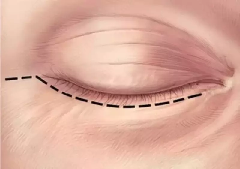 Пластика нижних век