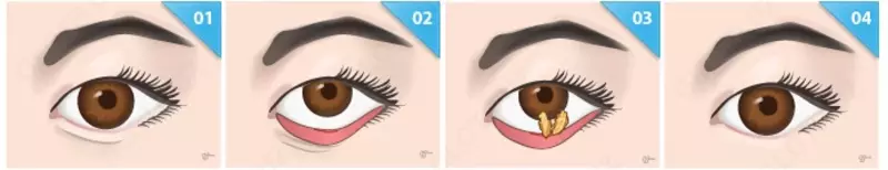 Пластика нижних век