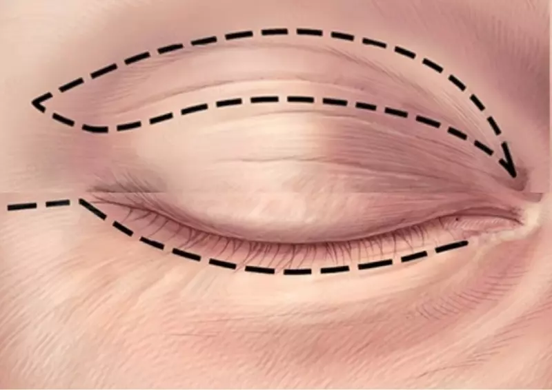 Пластика верхних и нижних век.