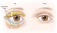 по запросу Пластика верхних и нижних век.