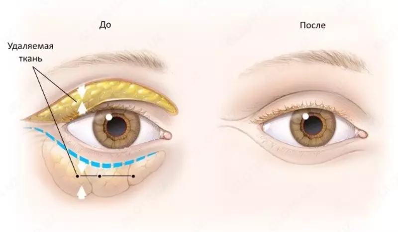 Пластика верхних и нижних век.