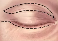 Круговая пластика ерхних и нижних век - по запросу