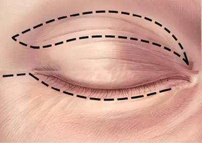 Круговая пластика ерхних и нижних век