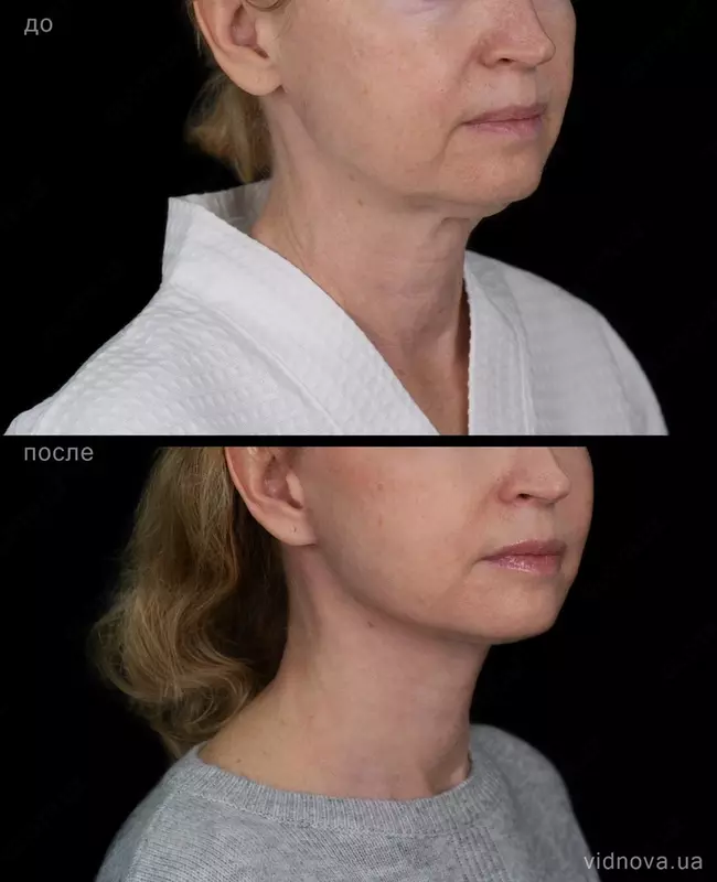 Круговая стяжка лица