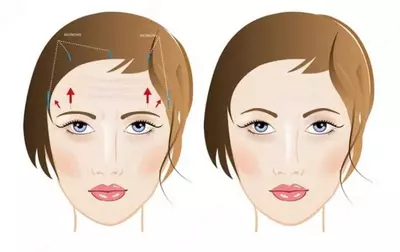 Подтяжка лба и бровей