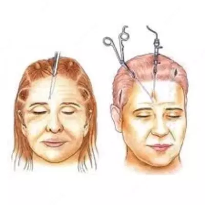 Подтяжка лба и бровей