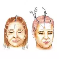 Подтяжка лба и бровей - по запросу