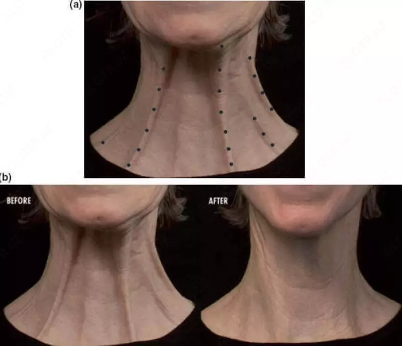 Платизмопластика. Подтяжка шеи