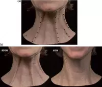 Платизмопластика. Подтяжка шеи