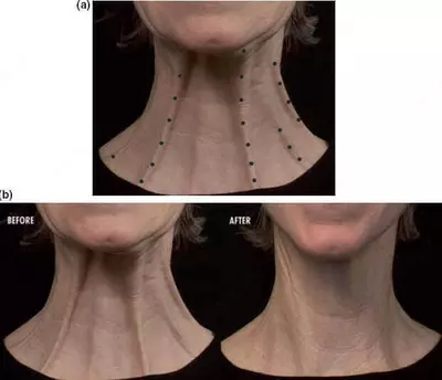 Платизмопластика. Подтяжка шеи