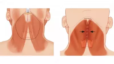 Платизмопластика. Подтяжка шеи