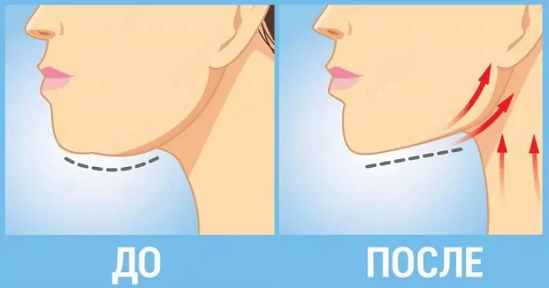 Пластическая хирургия. Удаление второго подбородка
