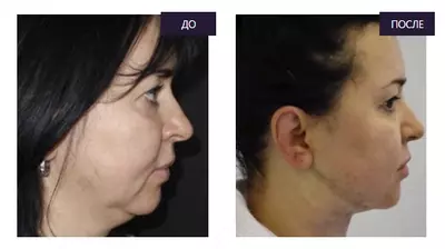 Пластическая хирургия. Удаление второго подбородка