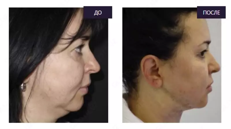 Пластическая хирургия. Удаление второго подбородка