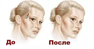 Пластическая хирургия. Височная подтяжка