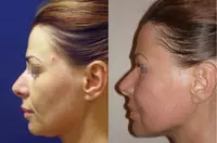 Plastik jarohlik. Chakkalarni tortirish - по запросу