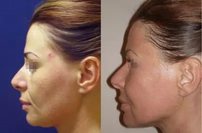 Пластическая хирургия. Височная подтяжка