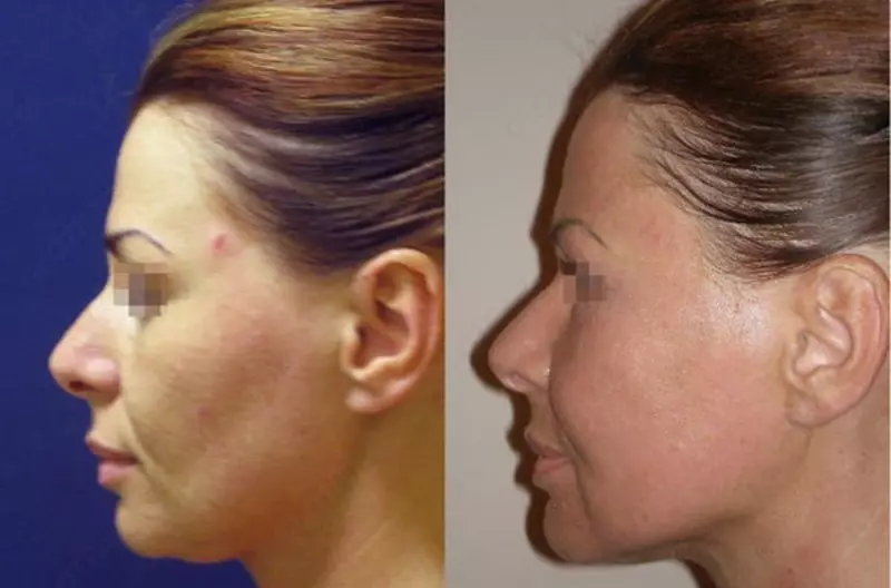 Пластическая хирургия. Височная подтяжка