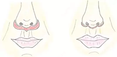 Пластическая хирургия. Подтяжка верхних губ