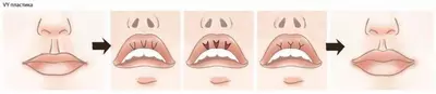 Пластическая хирургия. Подтяжка верхних губ