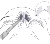 Plastik jarohlik. Burun plastik jarohligi - по запросу