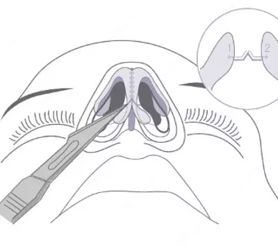 Пластическая хирургия: пластика носа