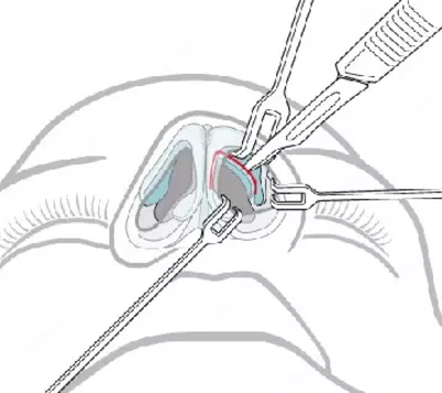 Пластическая хирургия: пластика носа