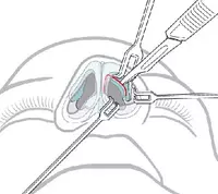 по запросу Plastik jarohlik. Burun plastik jarohligi