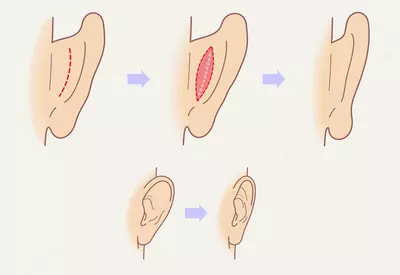 Пластическая хирургия: пластика уха