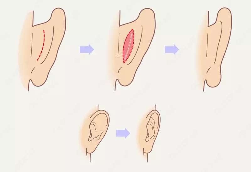Пластическая хирургия: пластика уха