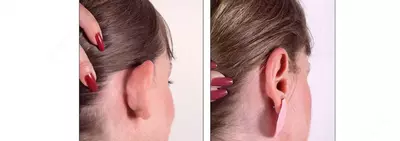 Пластическая хирургия: пластика уха