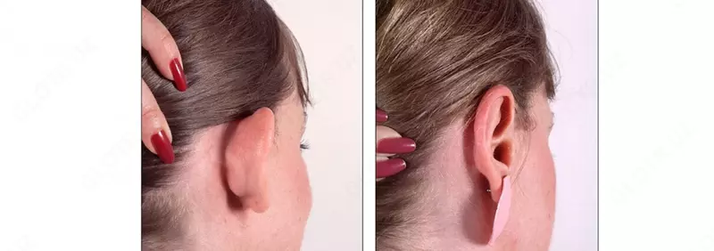 Пластическая хирургия: пластика уха