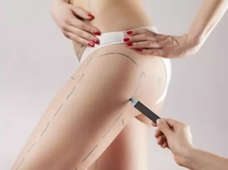 Пластическая хирургия: подтяжка бёдер