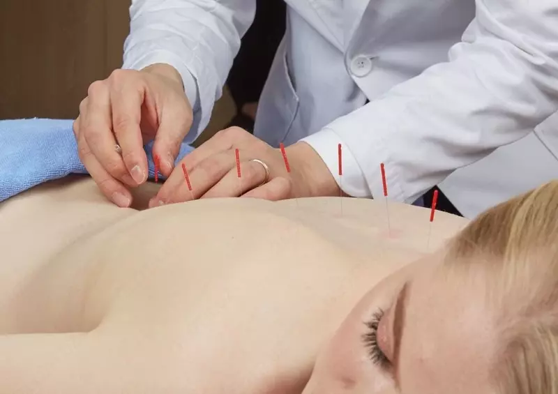 ИГЛОУКАЛЫВАНИЕ (акупунктура)