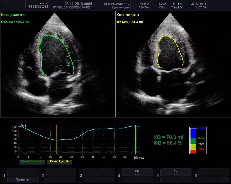 по запросу Эхокардиография