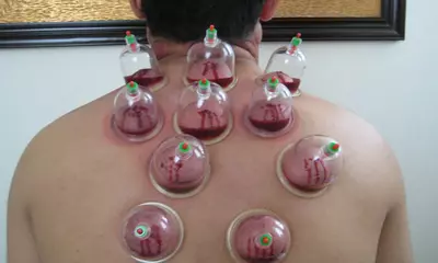 Hijama