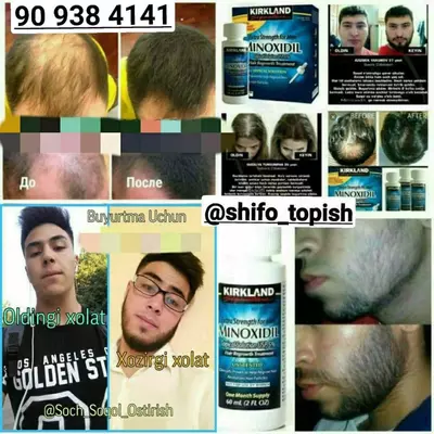 Миноксидил Киркланд 5% соч сокол остириш учун махсулот - 180 000 сум / шт.
