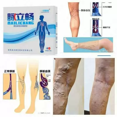 Натуральная мазь для лечения сосудистых заболеваний (мазь от варикоза)