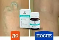 Qon tomir kasalliklarini davolash uchun tabiiy malham (varikoz tomirlari uchun malham) - 190 000 so'm