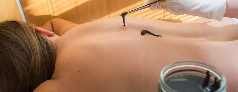 Гирудотерапия