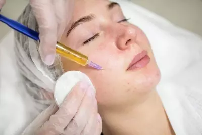 Плазмолифтинг