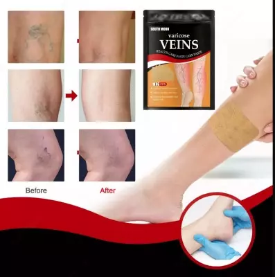 Varicose Veins Patch высокоэффективный пластырь от варикоза (Varikoz plastir)