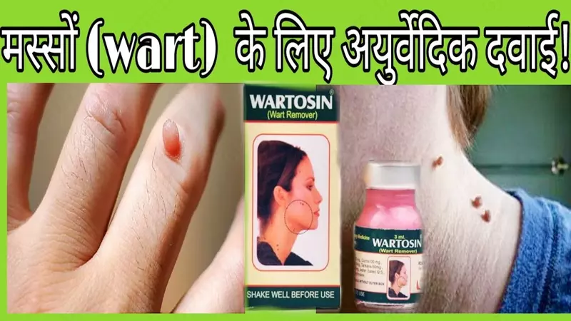 Вартосин от бородавок и папиллом (Wartosin Wart Remover)
