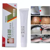 Мазь от витилиго Тианге Бай Бань (БайБань) Tiange